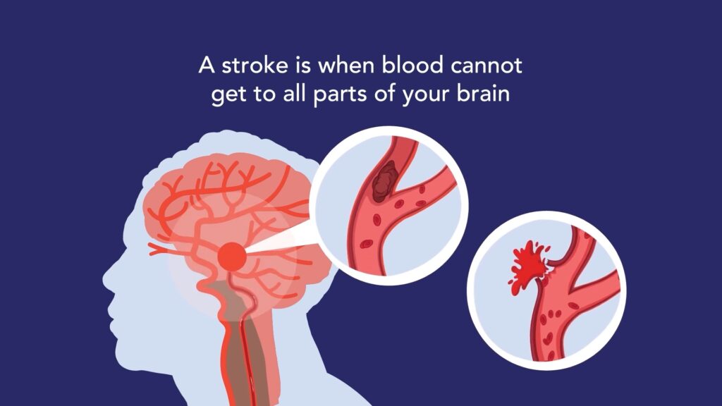 12 Things You Need to Know About Stroke - Stroke Foundation